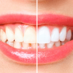 Onde fazer clareamento dental em Ribeirão Preto? Conheça a Mairake Odontologia Dentista 24h e obtenha um sorriso mais branco e saudável.