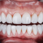 Procura onde fazer lentes de porcelana em Ribeirão Preto? A Mairake Odontologia Dentista 24h oferece transformação estética com resultados naturais e duradouros.